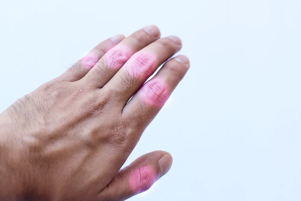 8 Homeopathy Remedies for Arthritis Patients